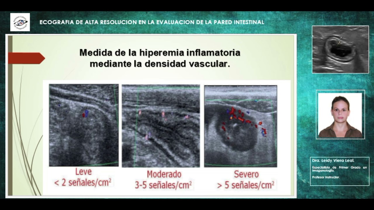 Ecografía de alta resolución en la enfermedad inflamatoria intestinal. Dra  Leidy Viera Leal