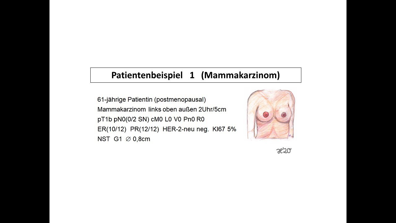 Beispiel 1 für die Behandlung eines Mammakarzinoms | Strahlentherapie Prof. Hilke Vorwerk