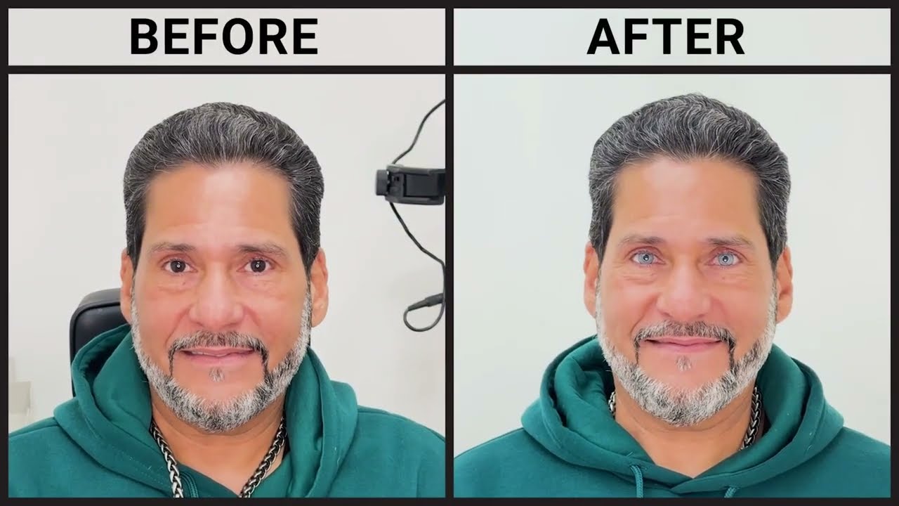 Safe Permanent Eye Color Change at KERATO Dr.Movshovich #keratopigmentation #tattoo #eyecolorchange