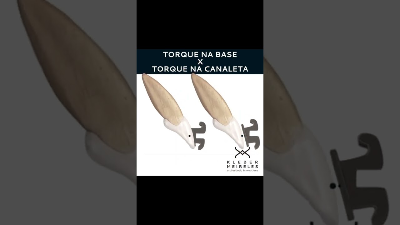TORQUES - ORTHODONTIC TIPS #Shorts