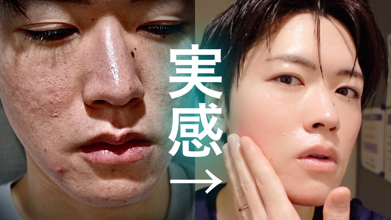 【毛穴 ニキビ】肌が変わったスキンケアルーティン『まとめ』