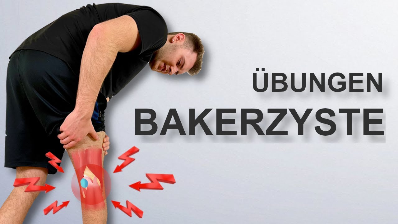 Schmerzen in der Kniekehle (Bakerzyste) | Soforthilfe