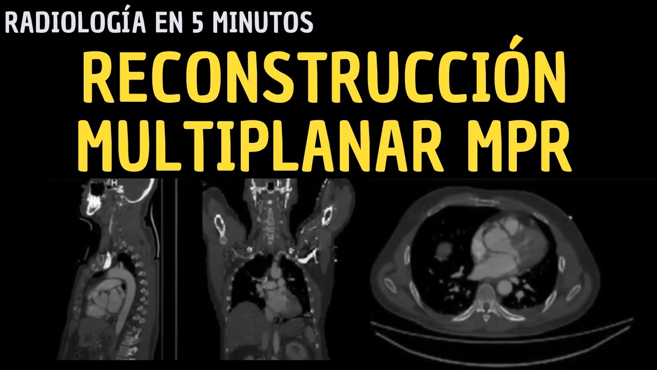 Radiolog&iacute;a en 5 minutos: Reconstrucci&oacute;n Multiplanar (MPR).