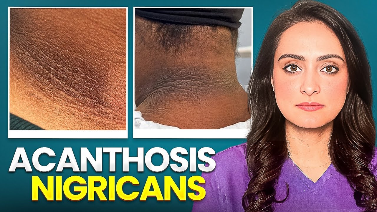 Acanthosis Nigricans explained !
