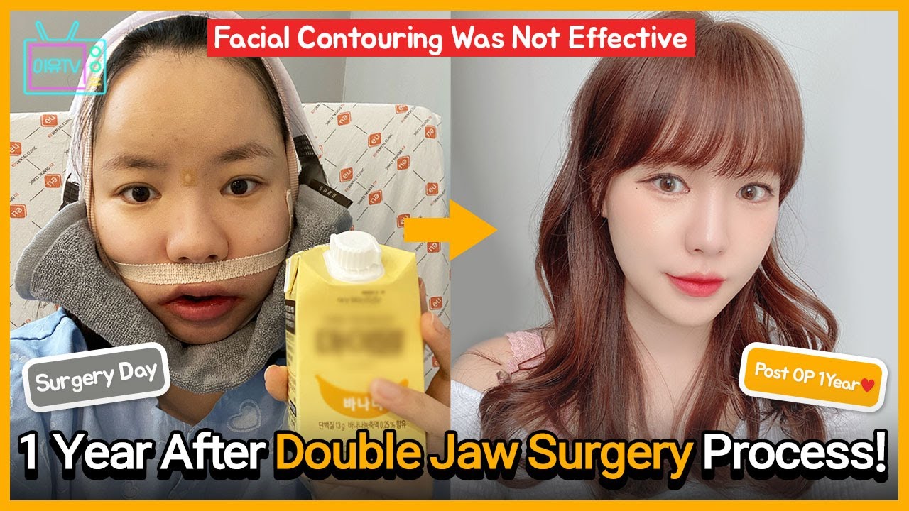 [EN/JP/TH/ SUB] 1 Year After Korean Double Jaw Surgery (Part 2)