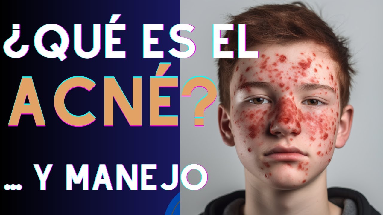 ¿Qué es el Acné y cómo se trata?