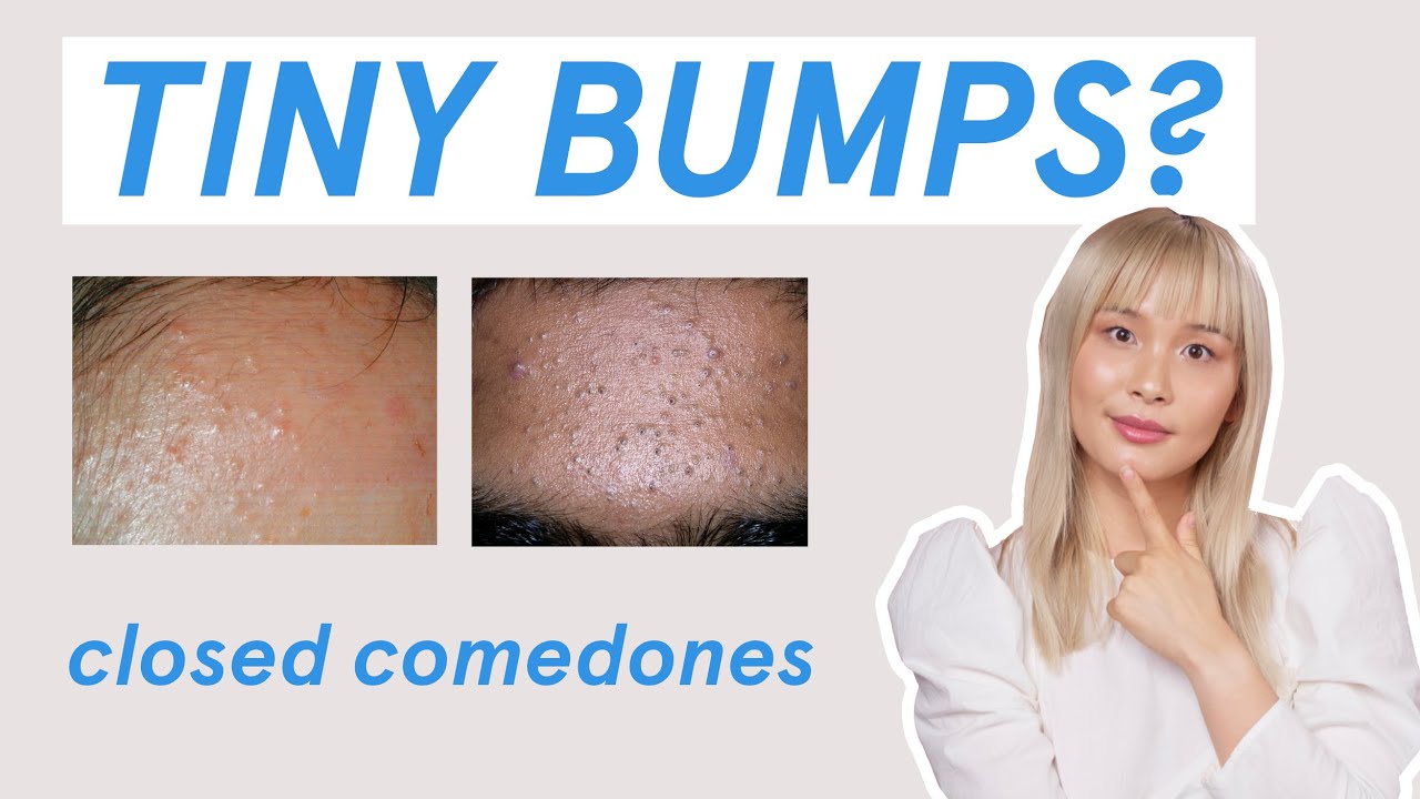 Why those tiny bumps AREN&rsquo;T fungal acne!