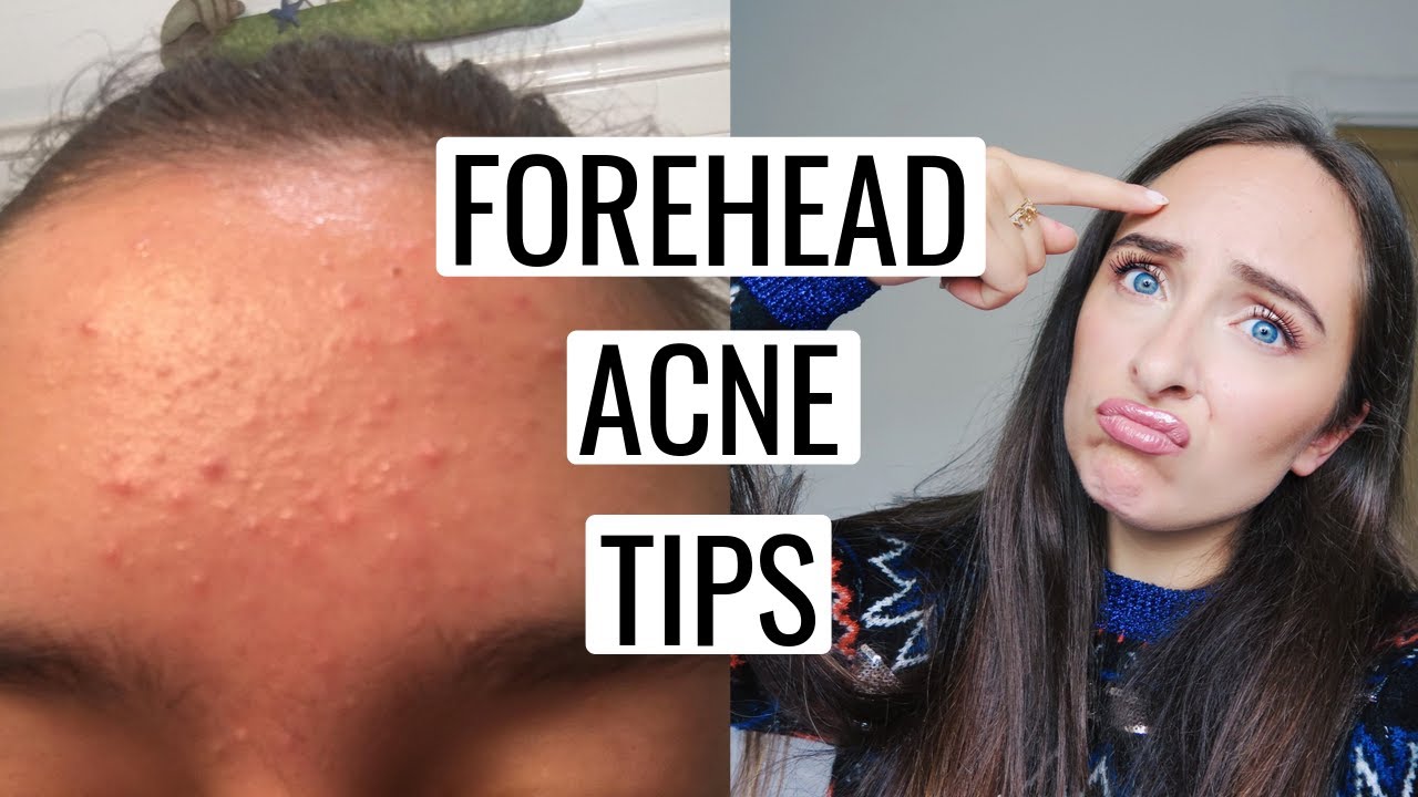 How To Get Rid Of FOREHEAD ACNE 🙌🏻