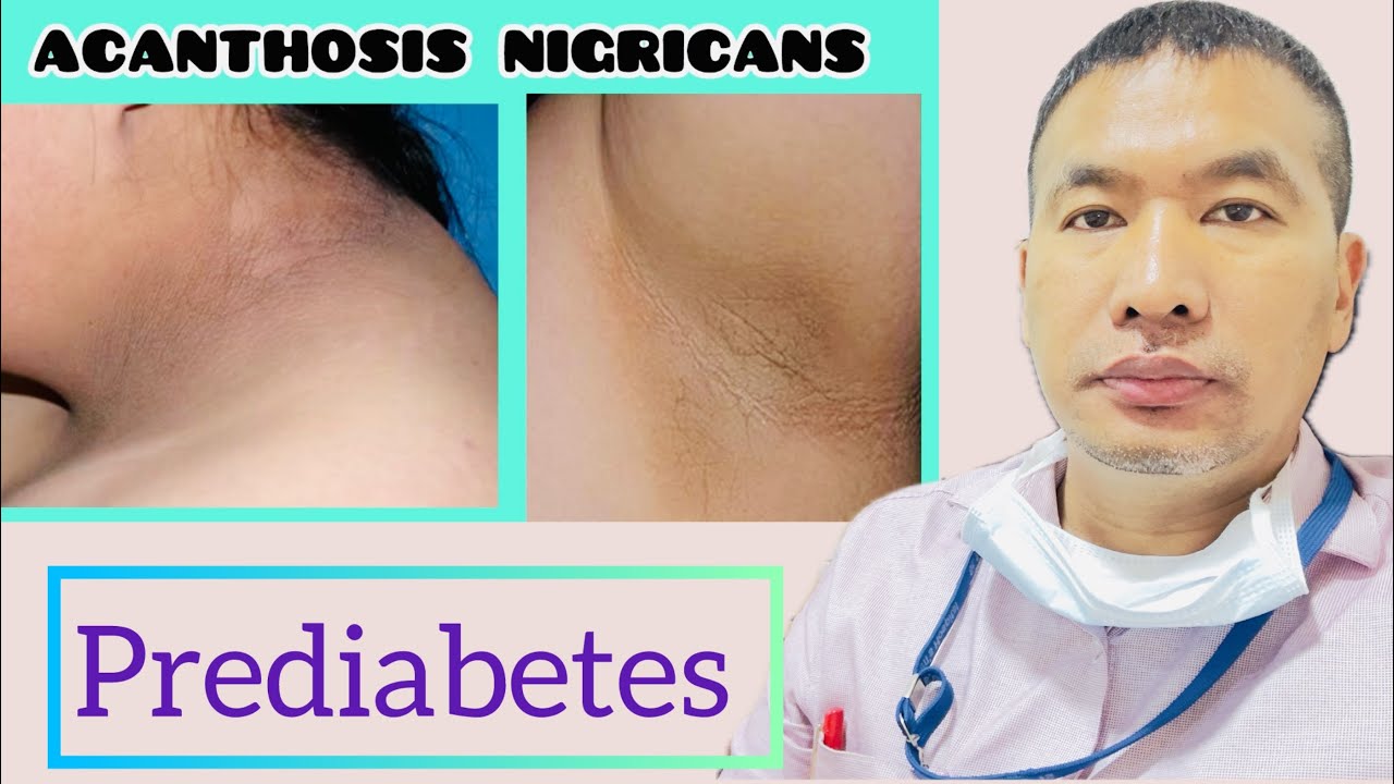 Understanding Prediabetes: A Guide to Preventing Type2 Diabetes || Nagamese.
