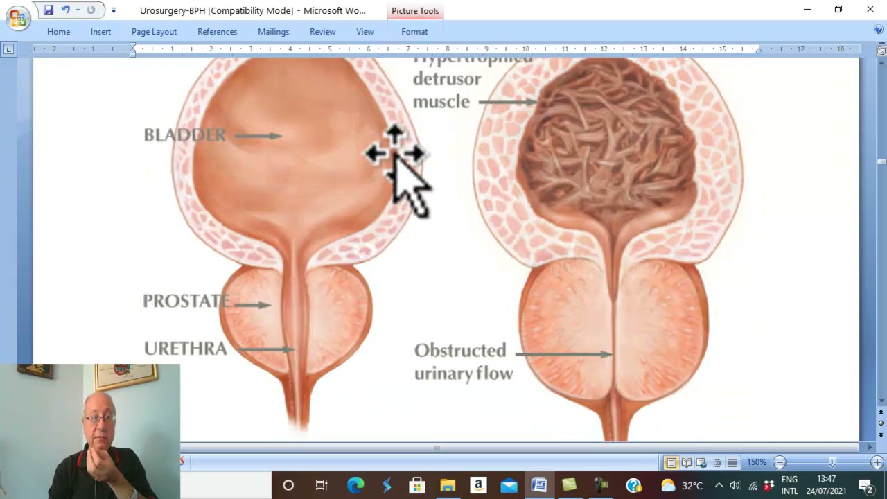 Urosurgery in Arabic 31 ( Benign Prostatic Hyperplasia , part 2  ) , by Dr. Wahdan