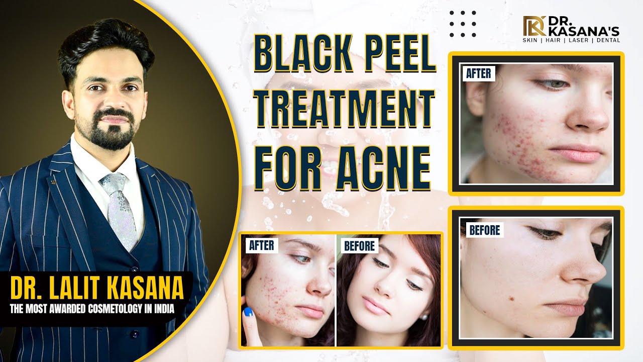 Black Peel Treatment for acne || Acne Treatment Facial Peel + Before and After Result