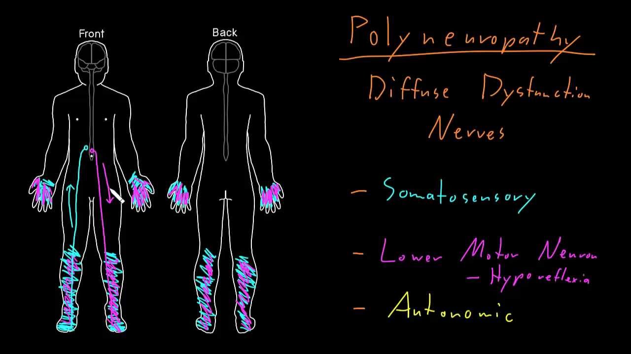 Syndrome: Polyneuropathy