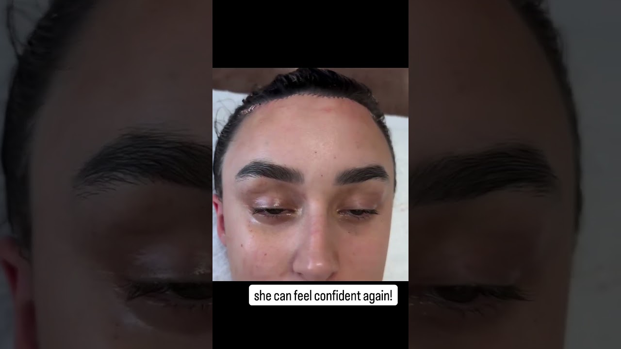 Hairline Lowering Before and After | Forehead Reduction