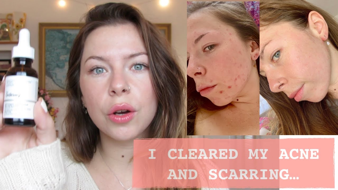 How Rose Hip Seed Oil Healed My Skin (with pictures)