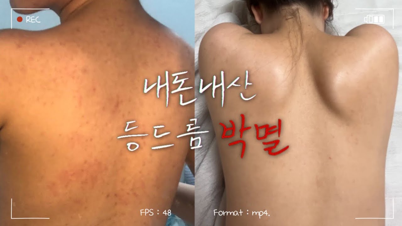 내돈내산 10년 묵은 등드름+가드름 박멸👊