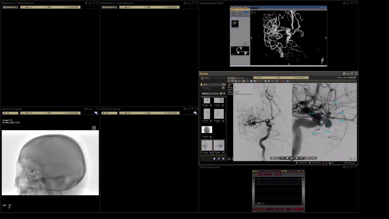 Case-4, MCA aneurysm, 04-03-2026