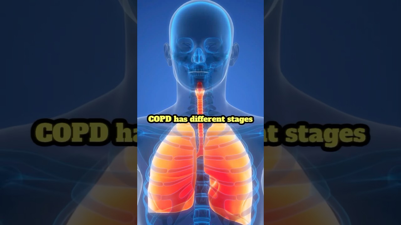 Стадии ХОБЛ объяснены #ХОБЛ #заболеваниелегких #легочнаяреабилитация