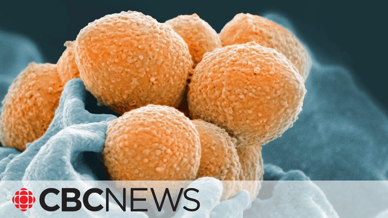 Invasive cases of Group A strep soar to record levels