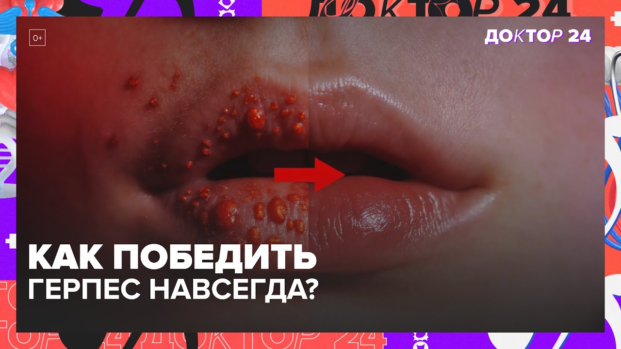 Почему появляется герпес на губах и как его лечить | Доктор 24
