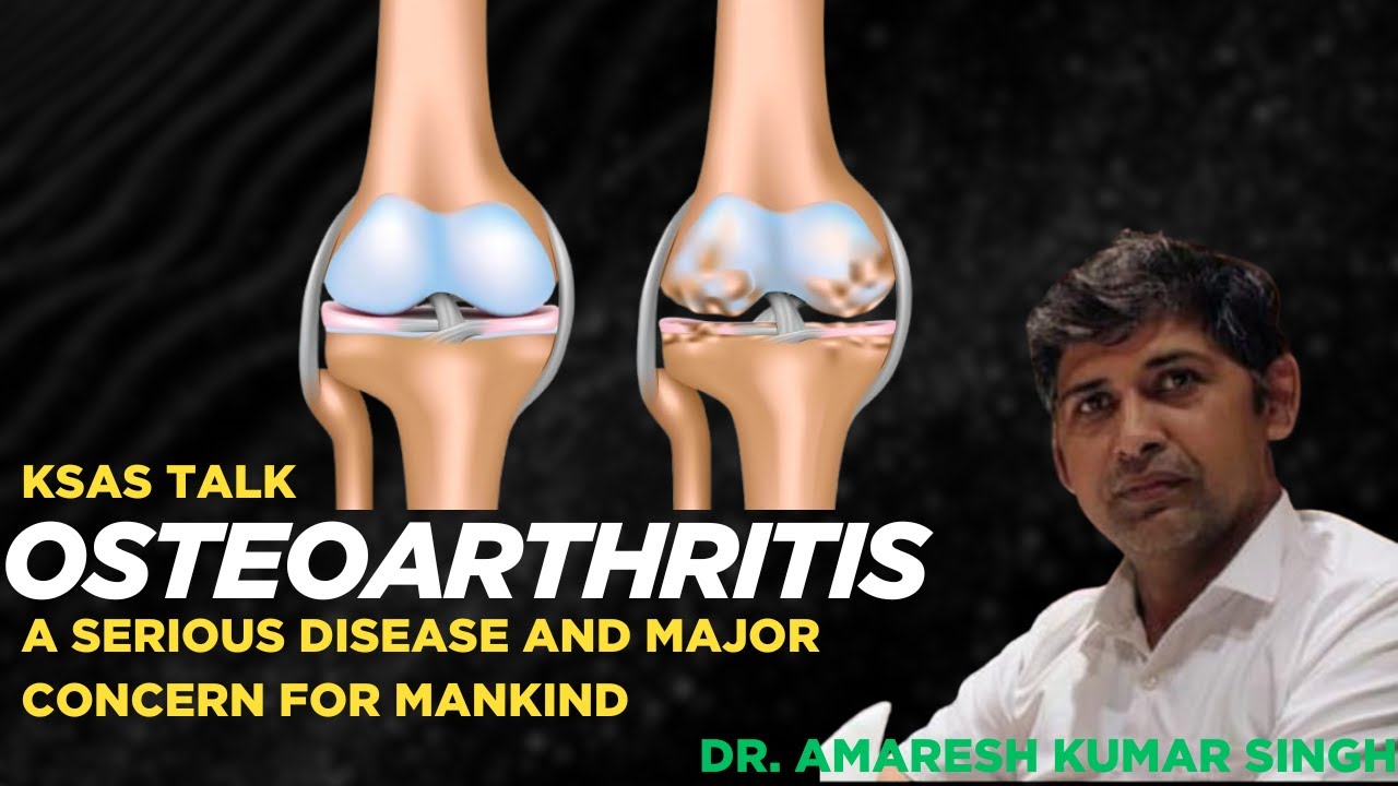 Osteoarthritis: A serious disease and major concern for mankind. KSAS TALK