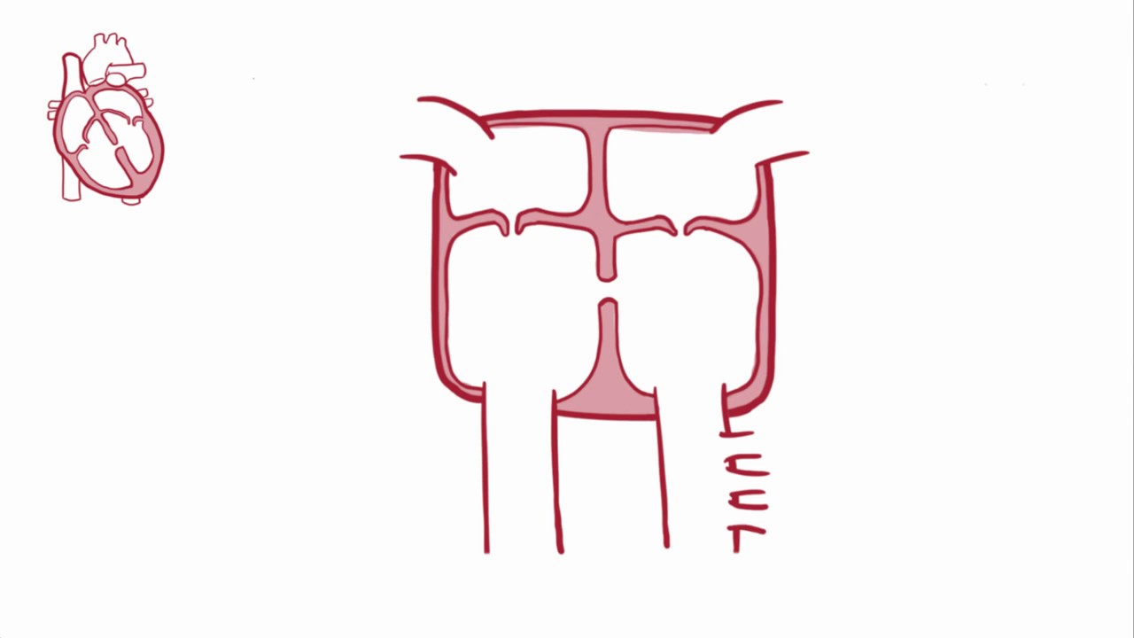Ventricular septal defect VSD   repair, causes, symptoms & pathology
