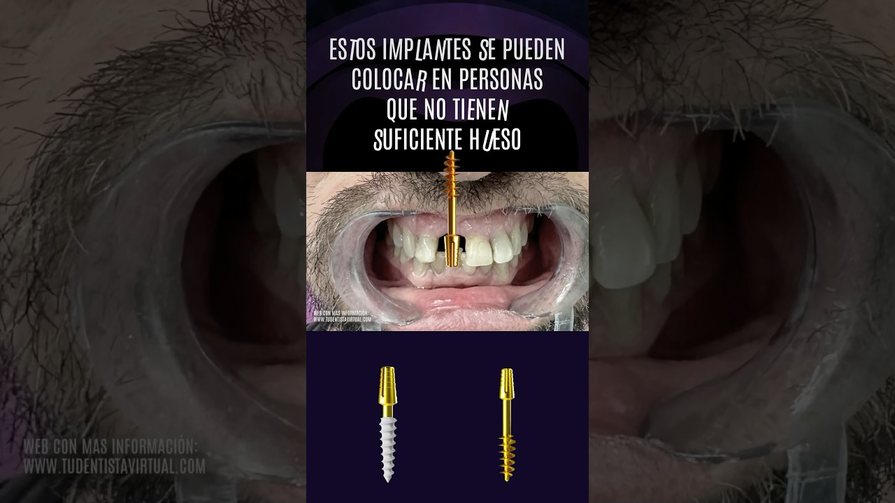 DIENTE FIJO SIN CIRUG&Iacute;A en POCAS HORAS con IMPLANTE MONOF&Aacute;SICO