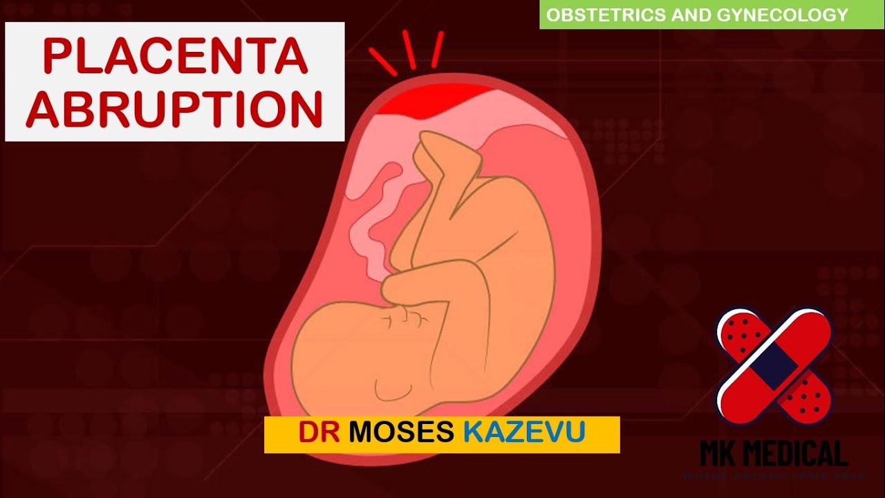 Placenta Abruption