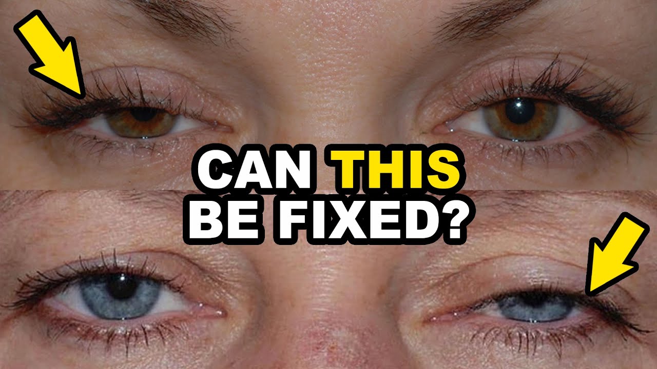 Can Eyelid Surgery CORRECT Ptosis? Plastic Surgeon Answers
