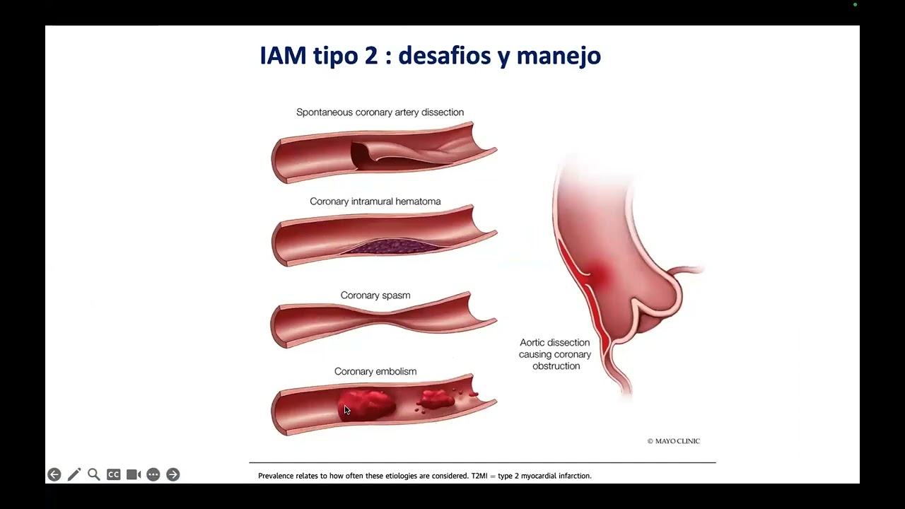 Infarto Agudo de Miocardio tipo 2  desafíos y manejo, Dr Helio Guimaraes