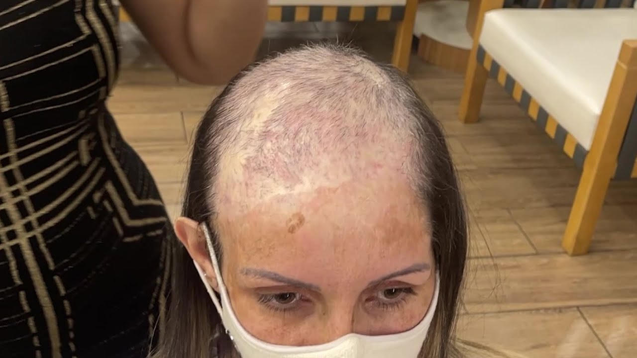 ALOPÉCIA POR TRAÇÃO/TRAUMÁTICA -  NÃO PRECISA DE IMPLANTE CAPILAR!