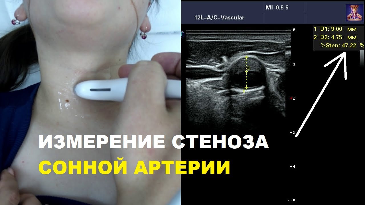Как измерить СТЕНОЗ сонной артерии на УЗИ?