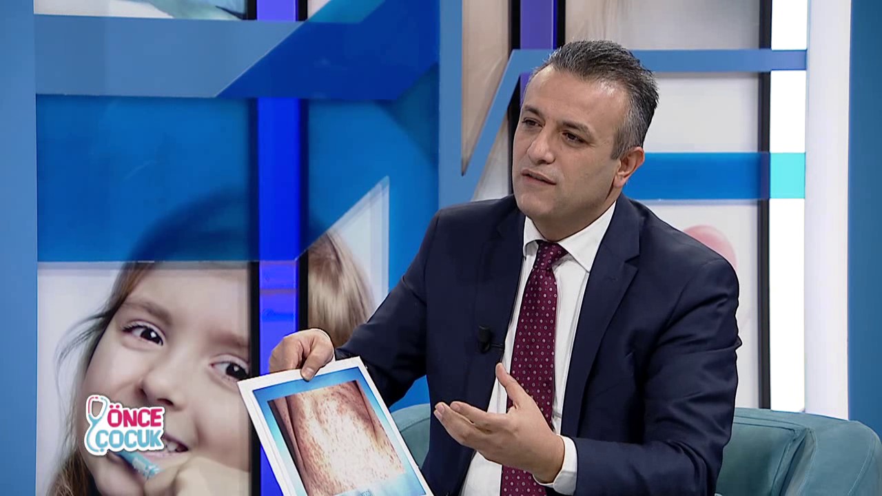 Önce Çocuk 536.Bölüm | Viral Döküntülü Hastalıklar