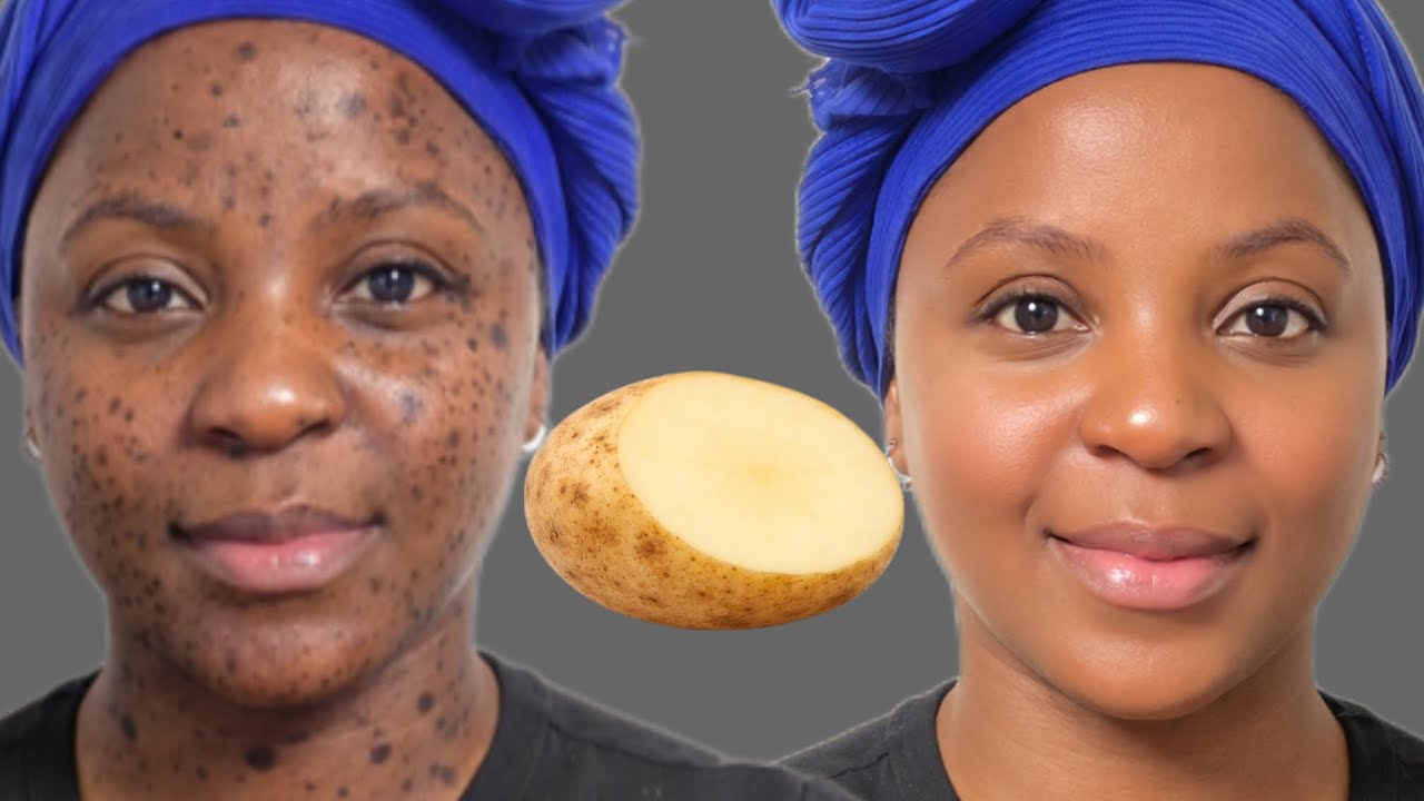I used This For 7 Days and Look my Skin Now!