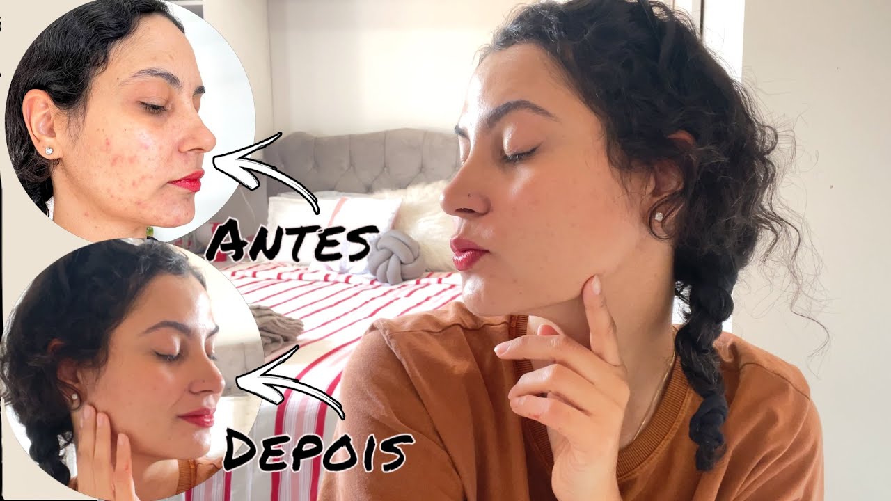 ACHEI UM PRODUTO MILAGROSO PARA ACNE + ATUALIZAÇÃO DO CANAL | CRIS MARIA