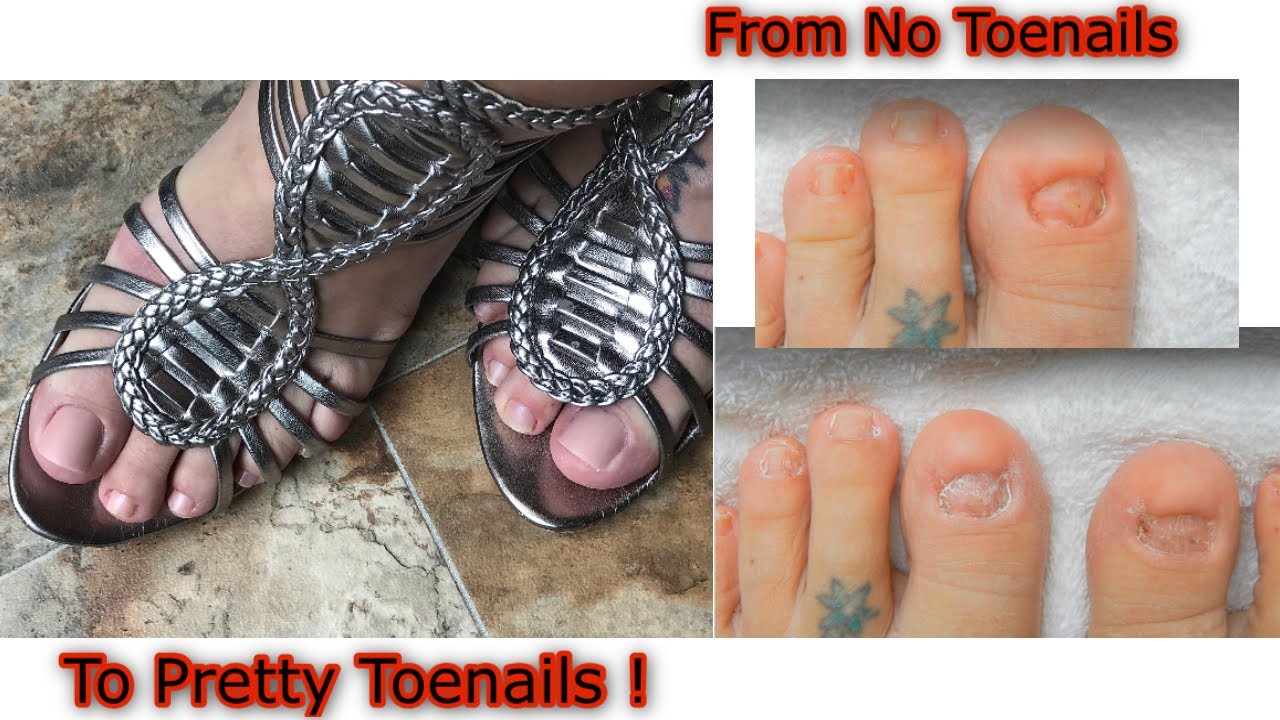 UGLY Missing Toenails  Made PRETTY AGAIN  Acrylic & Dual Forms - NO TOENAILS!