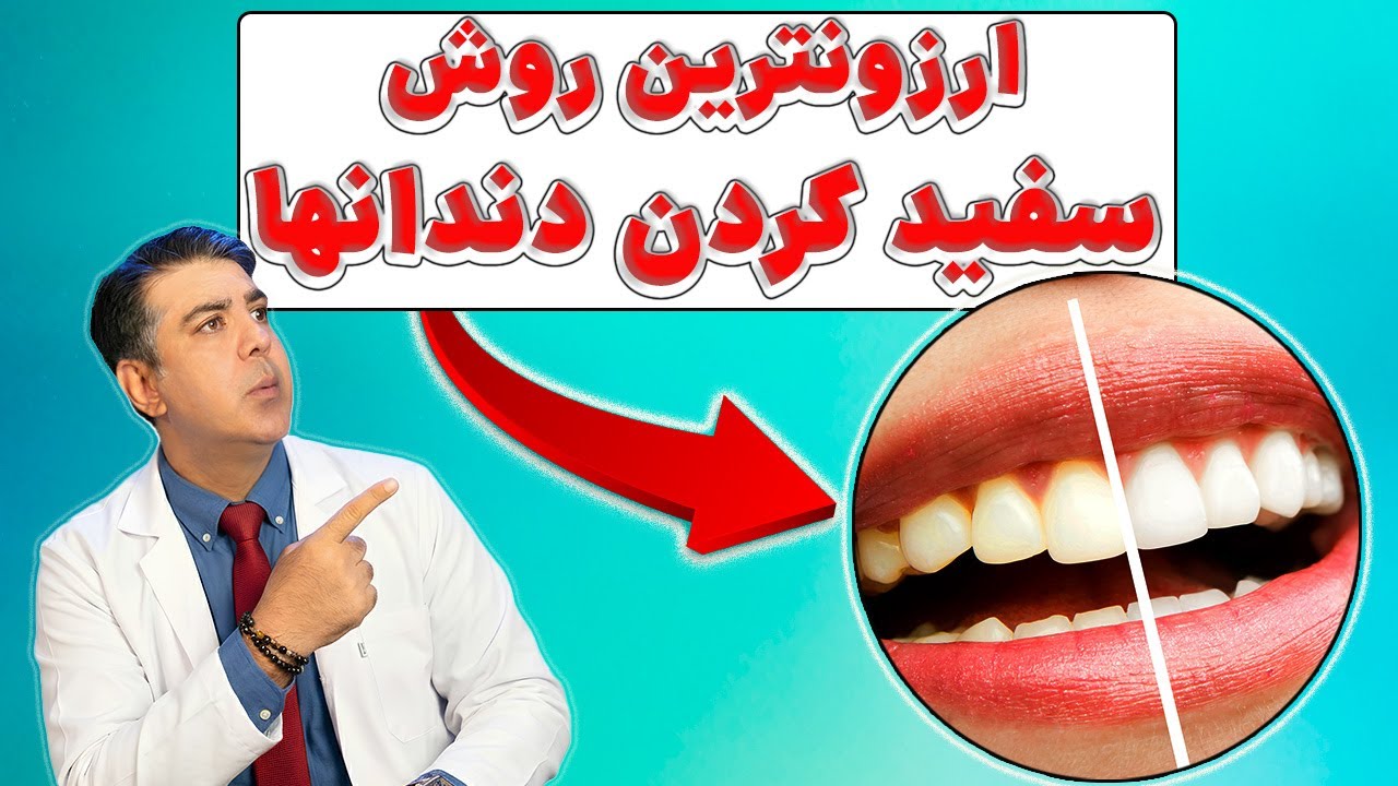باید ها و نبایدهای بلیچینگ دندانها