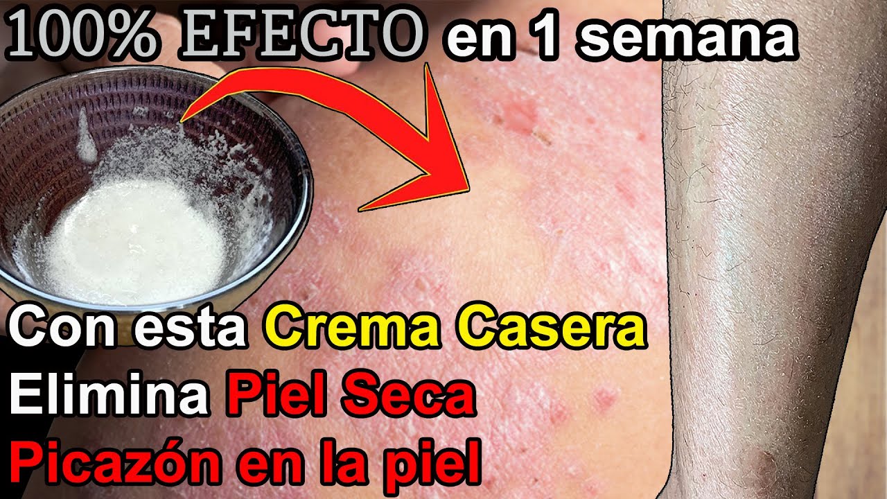 Cura Piel Seca (Xerosis) y Picaz&oacute;n en la piel en 15 d&iacute;as con este remedio casero 100% efectivo