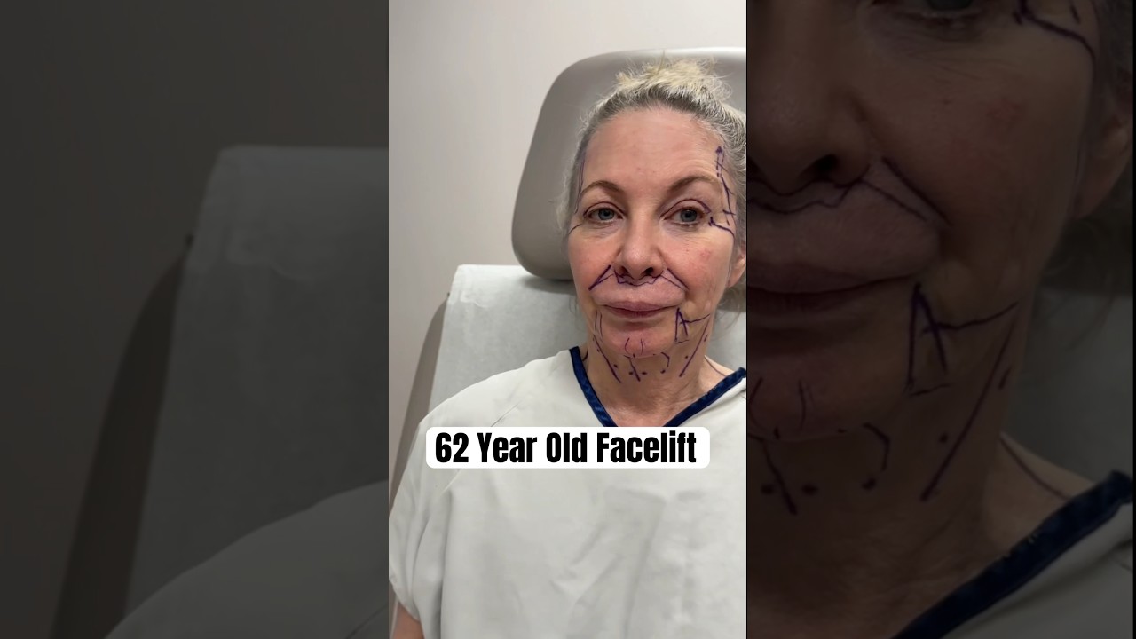 20 Years Taken Off! Facelift on a 62 Year Old 🤩