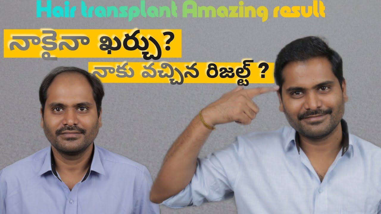 బట్టతలకు సోల్యూషన్ Hair transplantation amazing results ! Cost 