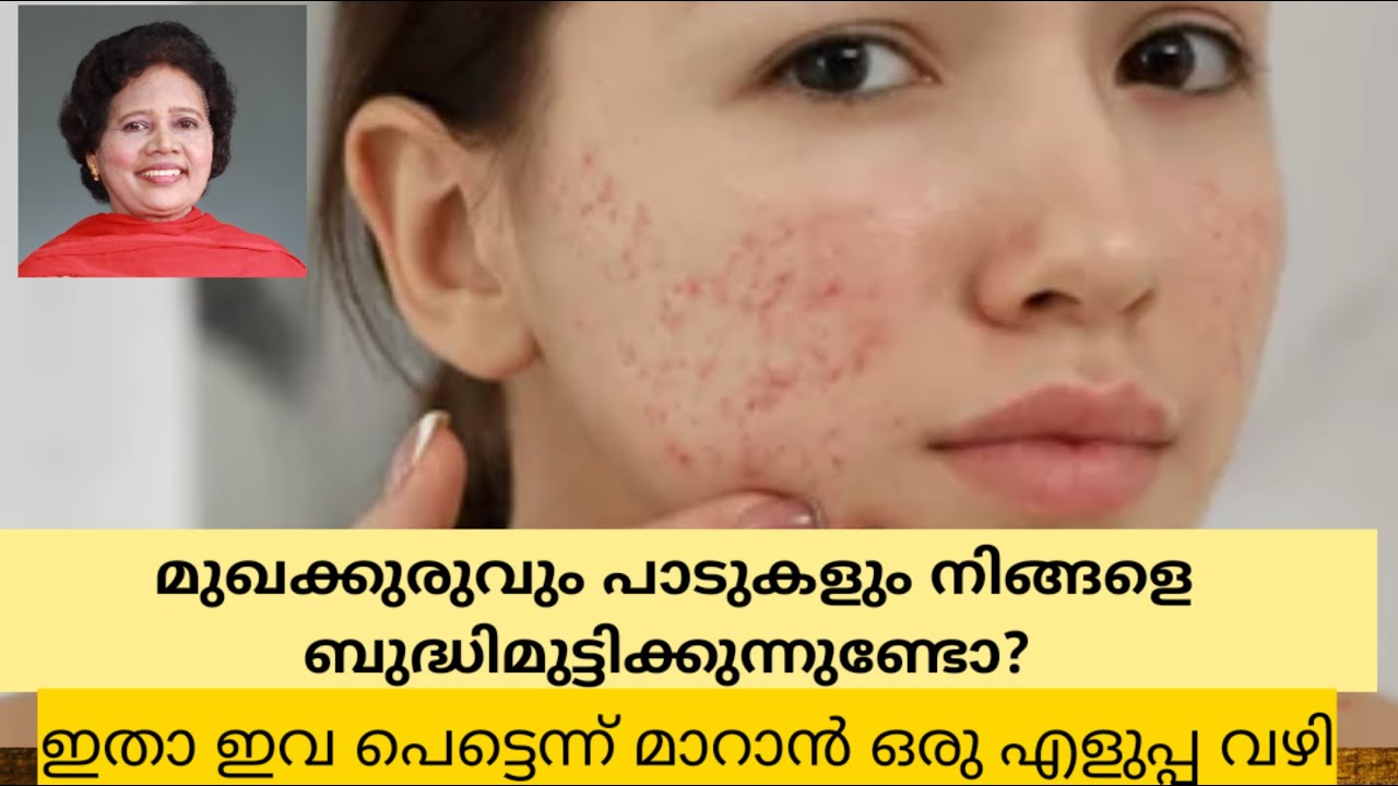 മുഖക്കുരു, കറുത്ത പാടുകൾ എന്നിവ സുഖപ്പെടാൻ | Dr Lizy K Vaidian