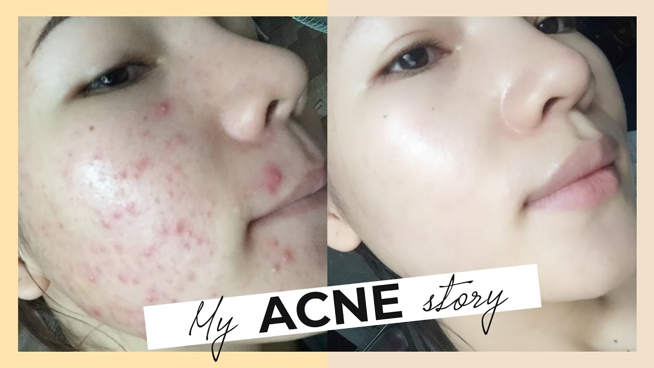 SKINCARE VÀ CHẾ ĐỘ SINH HOẠT KHI BỊ MỤN | NHẬT KÝ TRỊ MỤN TỪ A - Z CỦA CHANG