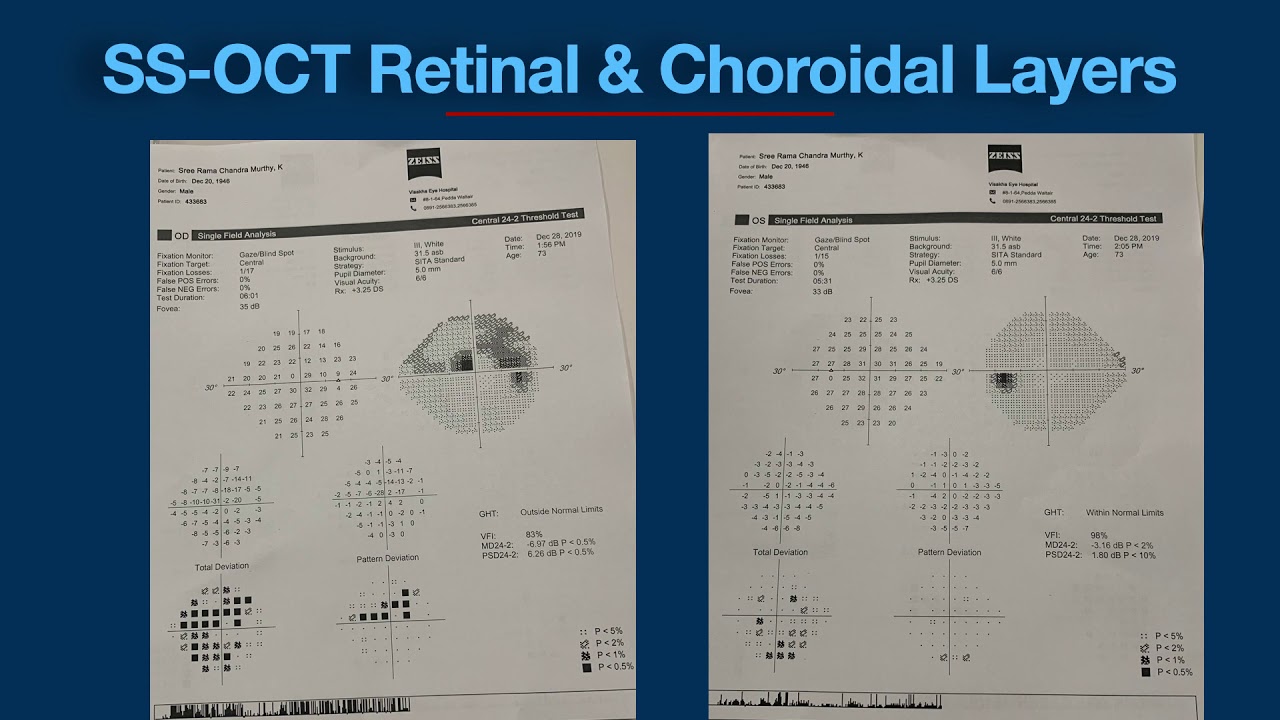 SS OCT in Glaucoma