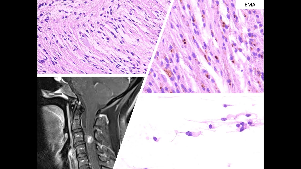 EPENDIMOMA TANICITICO | NEUROPATOLOGIA | CMNSXXI | IMSS | UNAM | SECIHTI