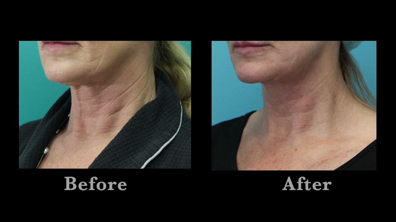 Erbium Resurfacing Laser Treatment for the Neck