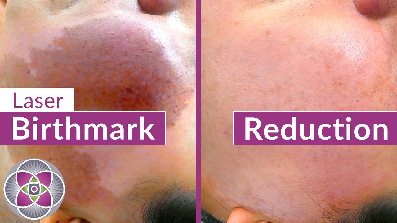 Laser Birthmark Removal of Port-Wine Stains & Cafe-Au-Lait Spots