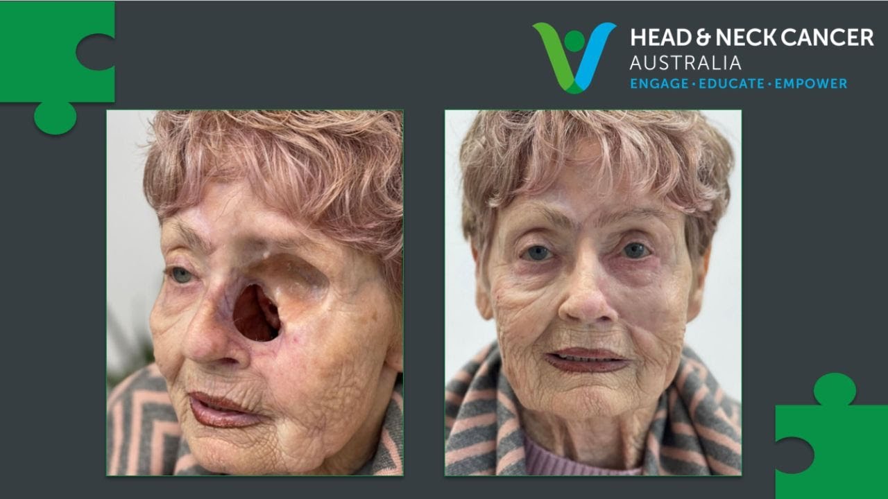 2024 Parliamentary Lunch: Head and Neck Cancer: A Critical Gap in Recovery