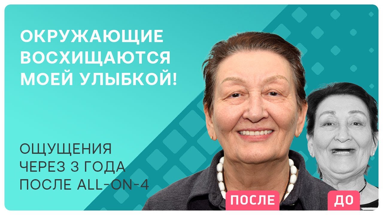 Почему врачи выбирают all-on-4? Личный опыт пациента и отзыв 3 года спустя