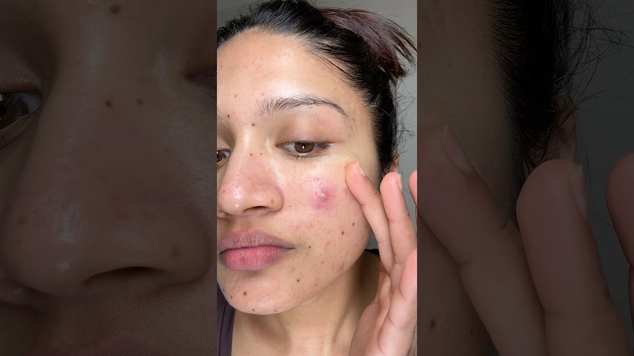 Night skincare routine for acne prone skin