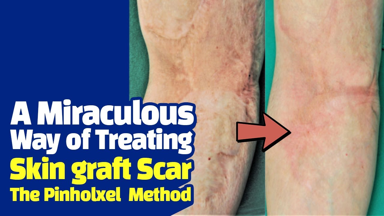 Skin graft scar laser treatment Pinholxel Method