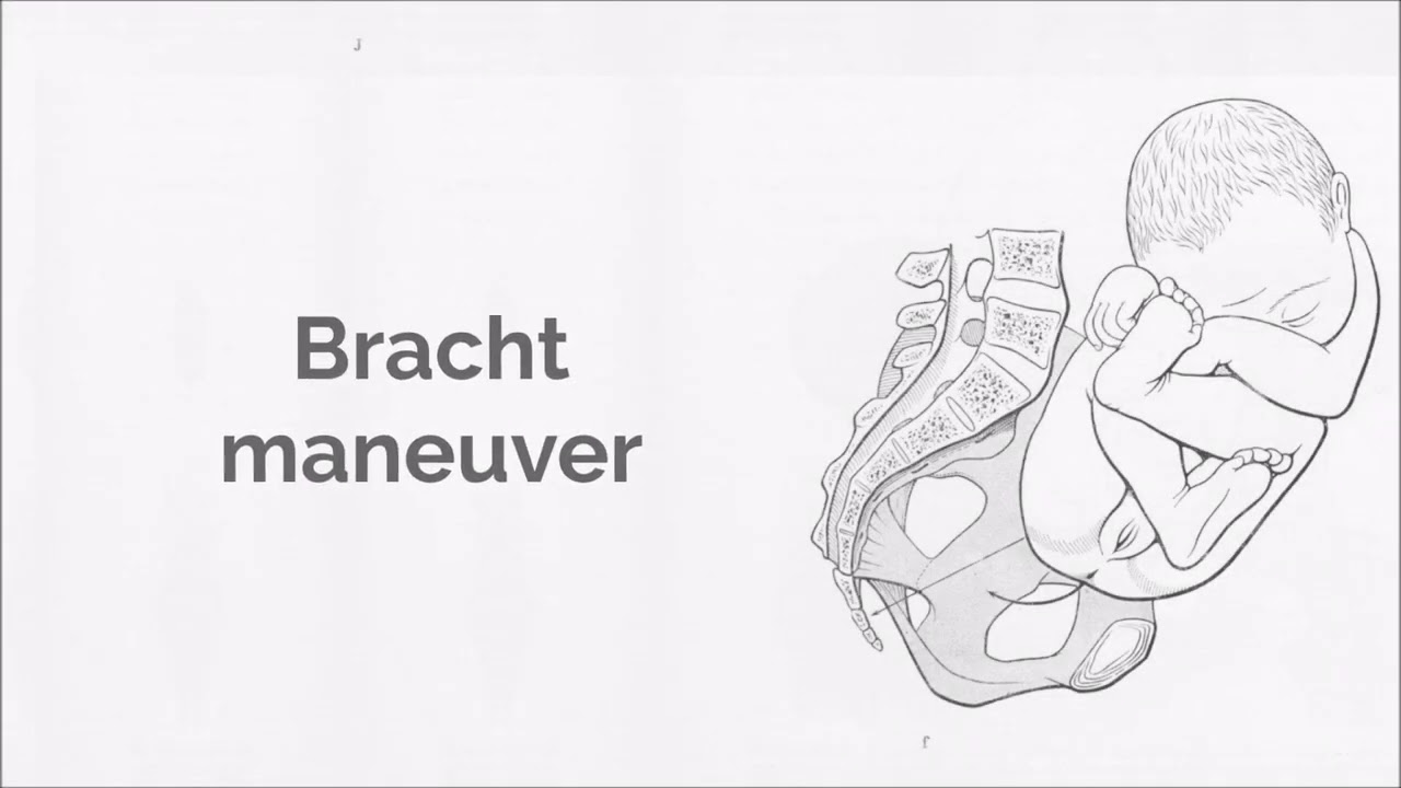 Bracht maneuver